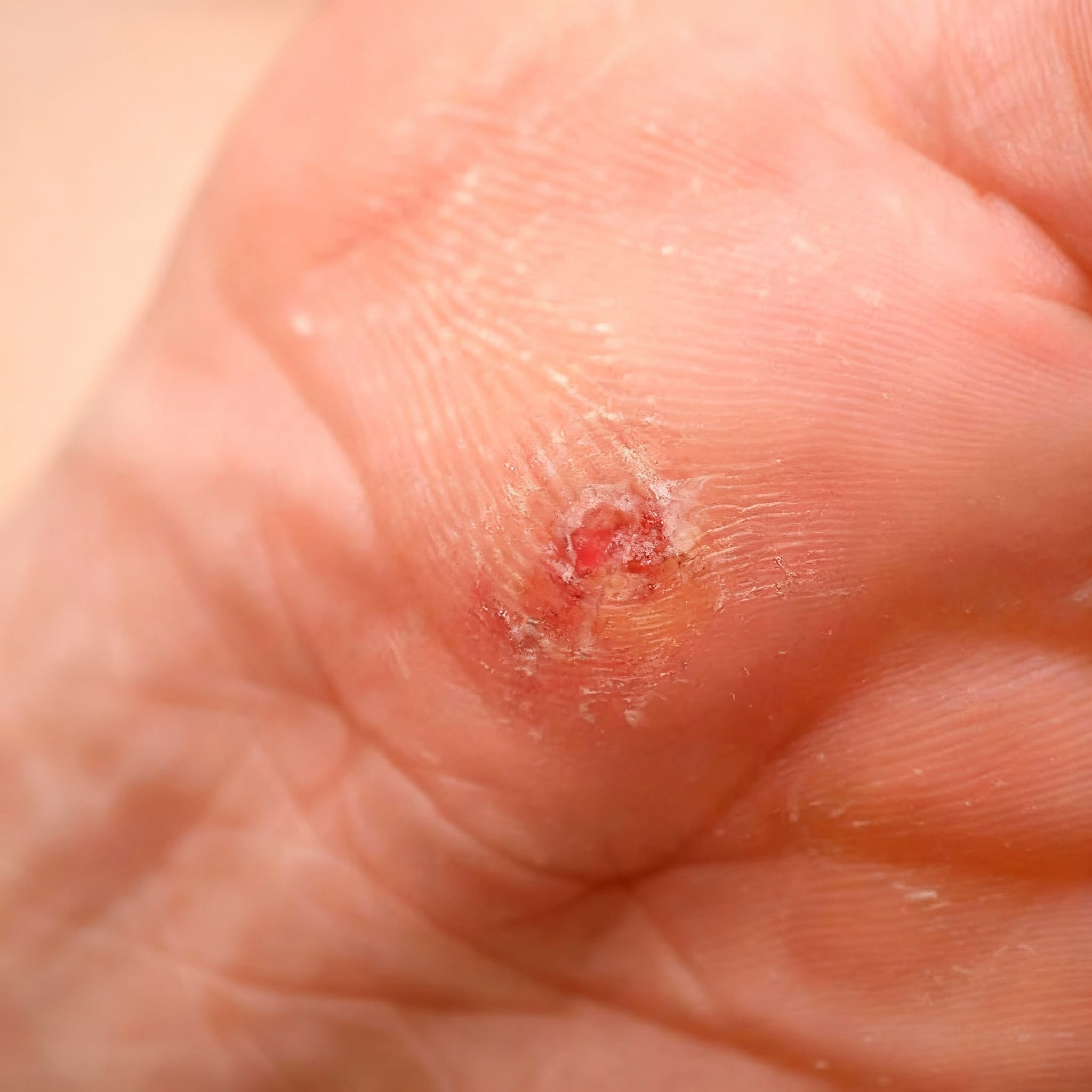 Tretman kurjeglavih (nasira)